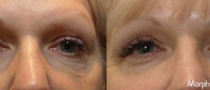 BF_Morpheus8_1a_Front-2