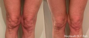 FR_Morpheus8_2a_2tx-2