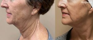 JL_Morpheus8_2a-scaled-2