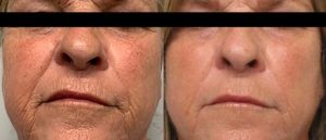 SH_M8_1_FacePerioNeck_1tx-2